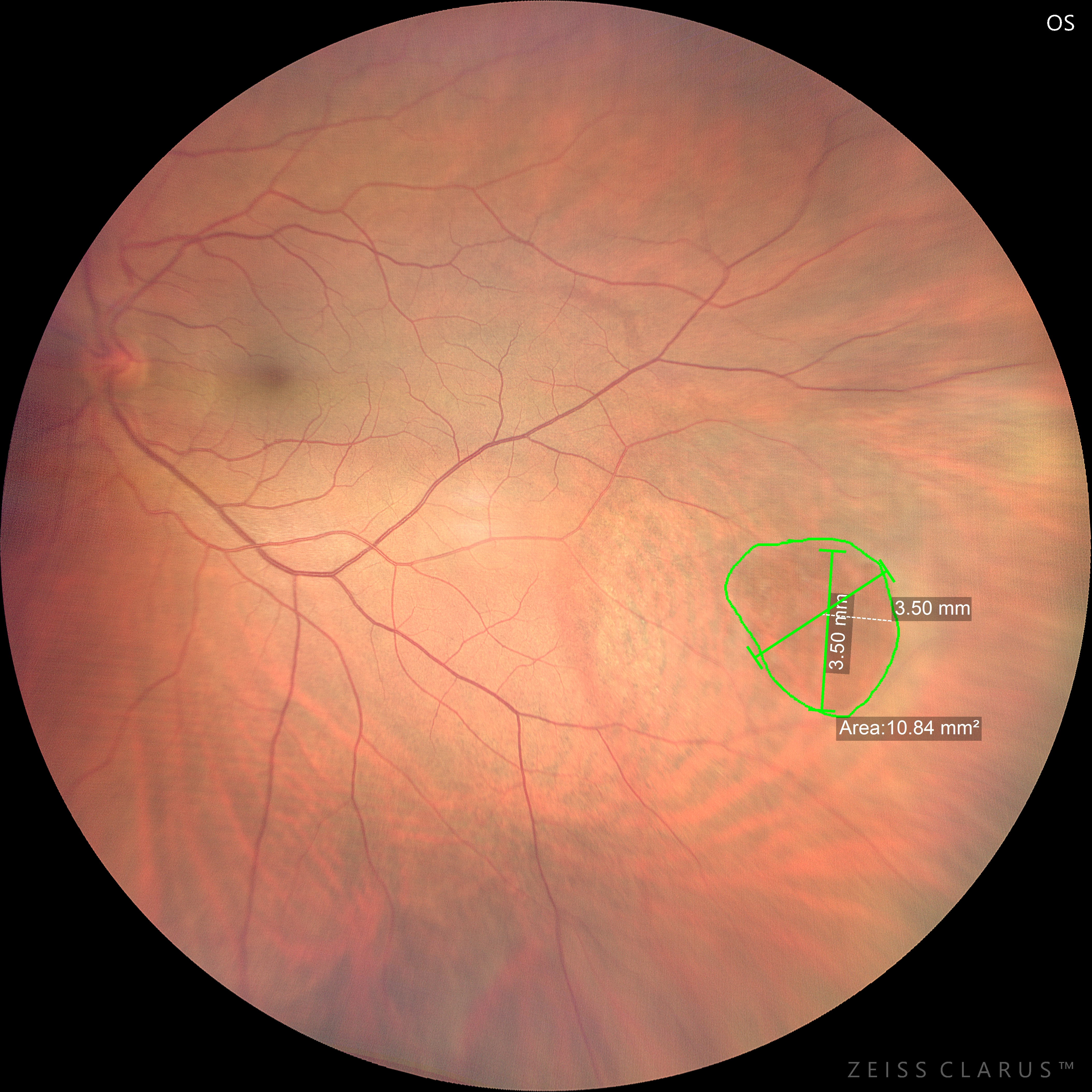 Misurazioni lineari e di area con imaging ultra widefield di un foro retinico periferico gigante
